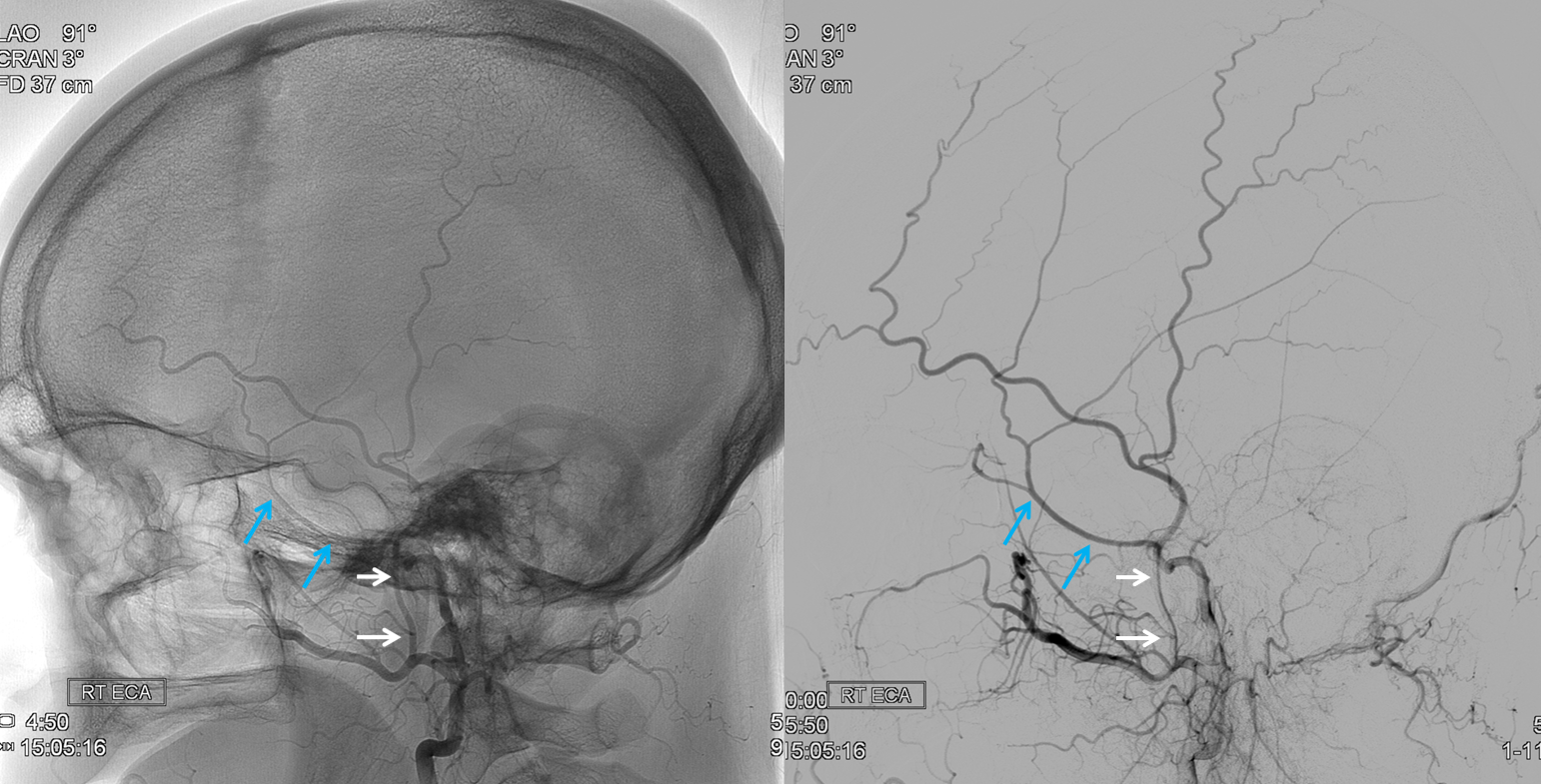 http://www.neuroangio.org/wp-content/uploads/Venous/V_tentorial_sinus_foramen_spinosum_3.png