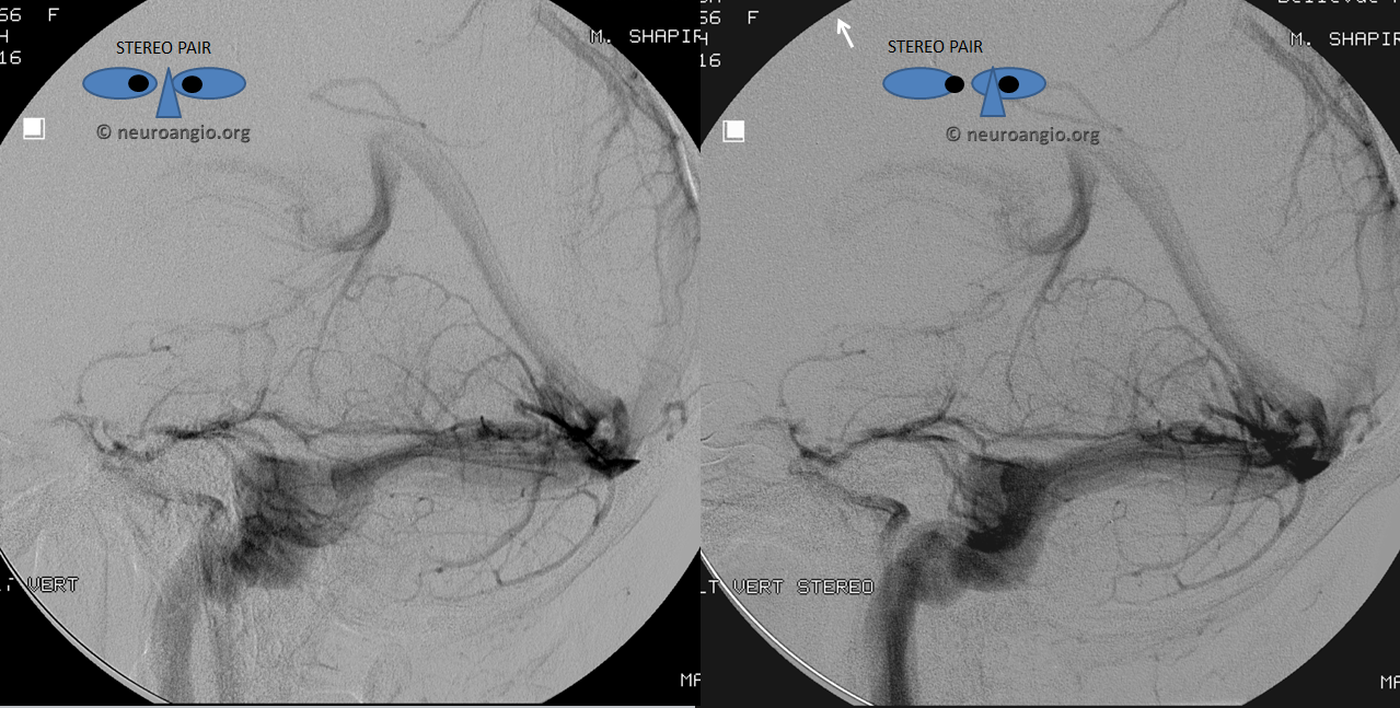 http://www.neuroangio.org/wp-content/uploads/Venous/V_vermis_stereo.png