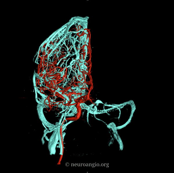 The larger superficial cerebral veins, including those draining the