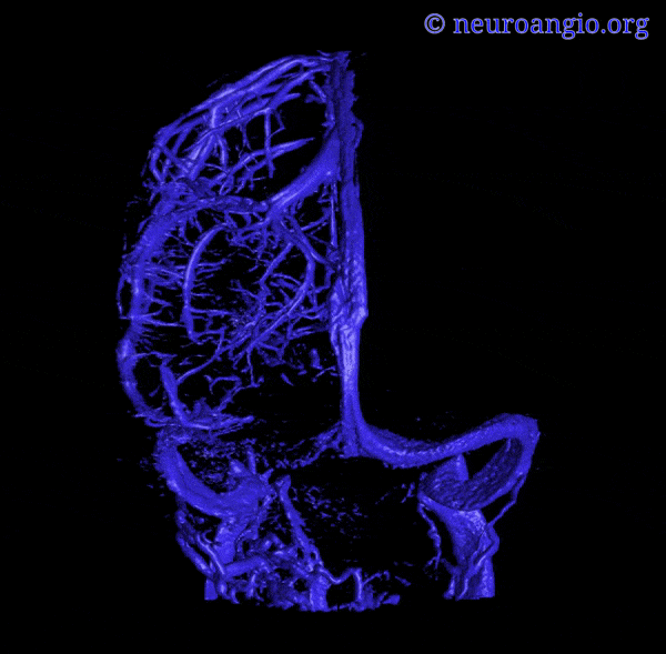 Superior cerebral veins - Wikipedia