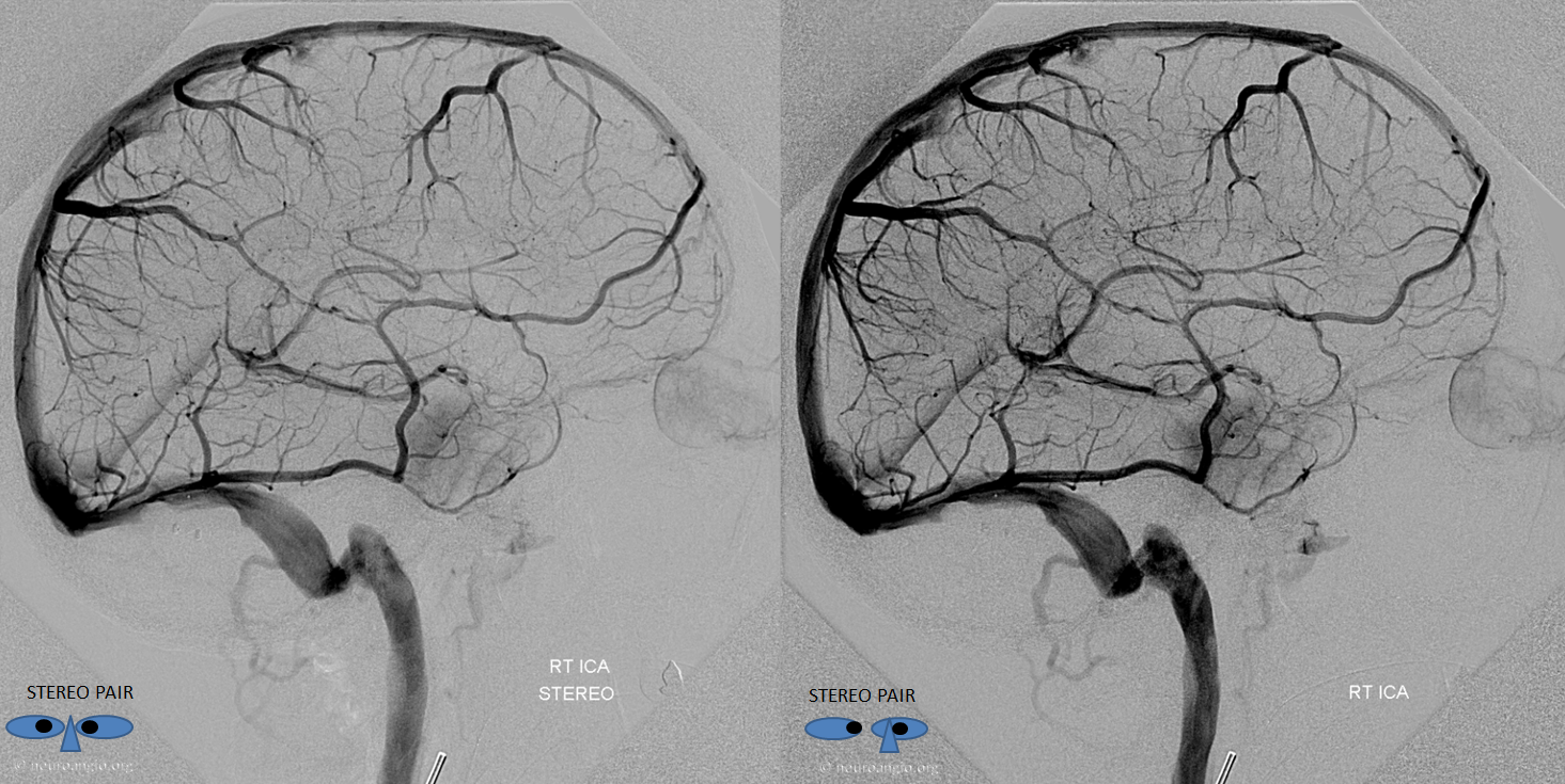 Labbe to anterior frontal vein collateral