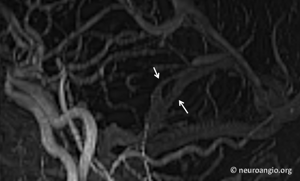 sigmoid sinus fenestration