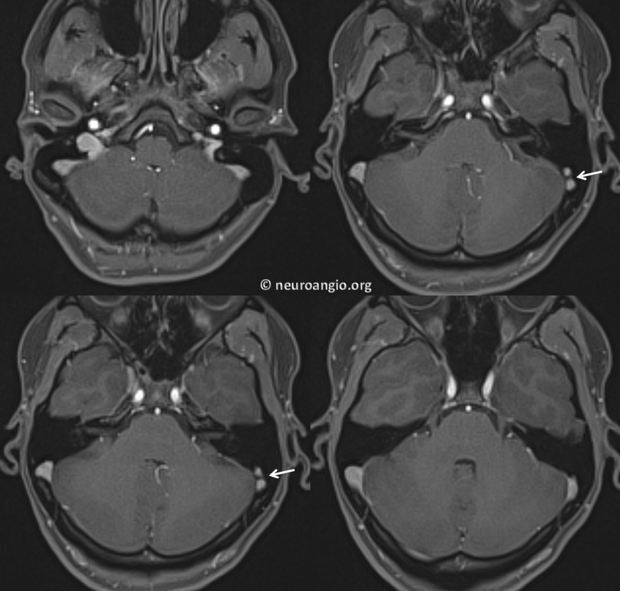 sigmoid sinus fenestration pulsatile tinnitus