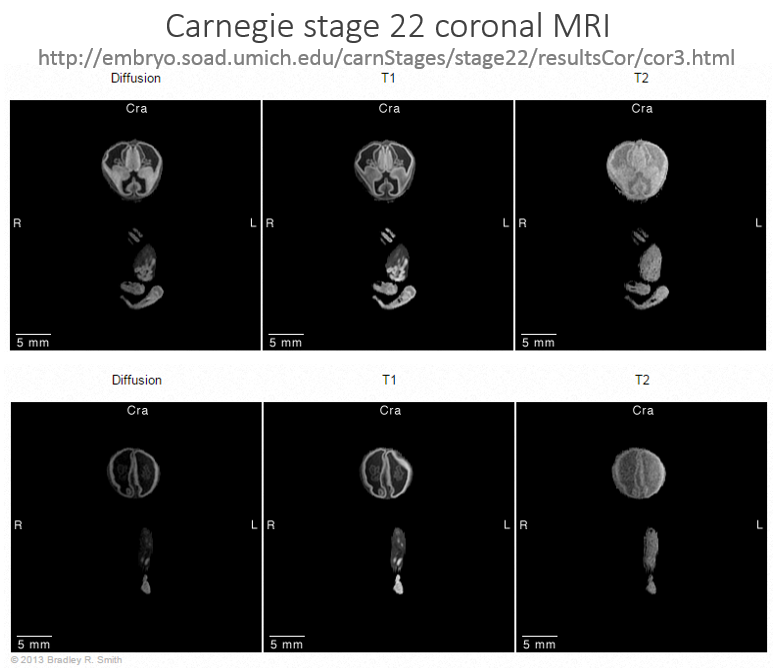 http://www.neuroangio.org/wp-content/uploads/Venous_Embryology/Venous_Embryology_neuroangio_16.PNG