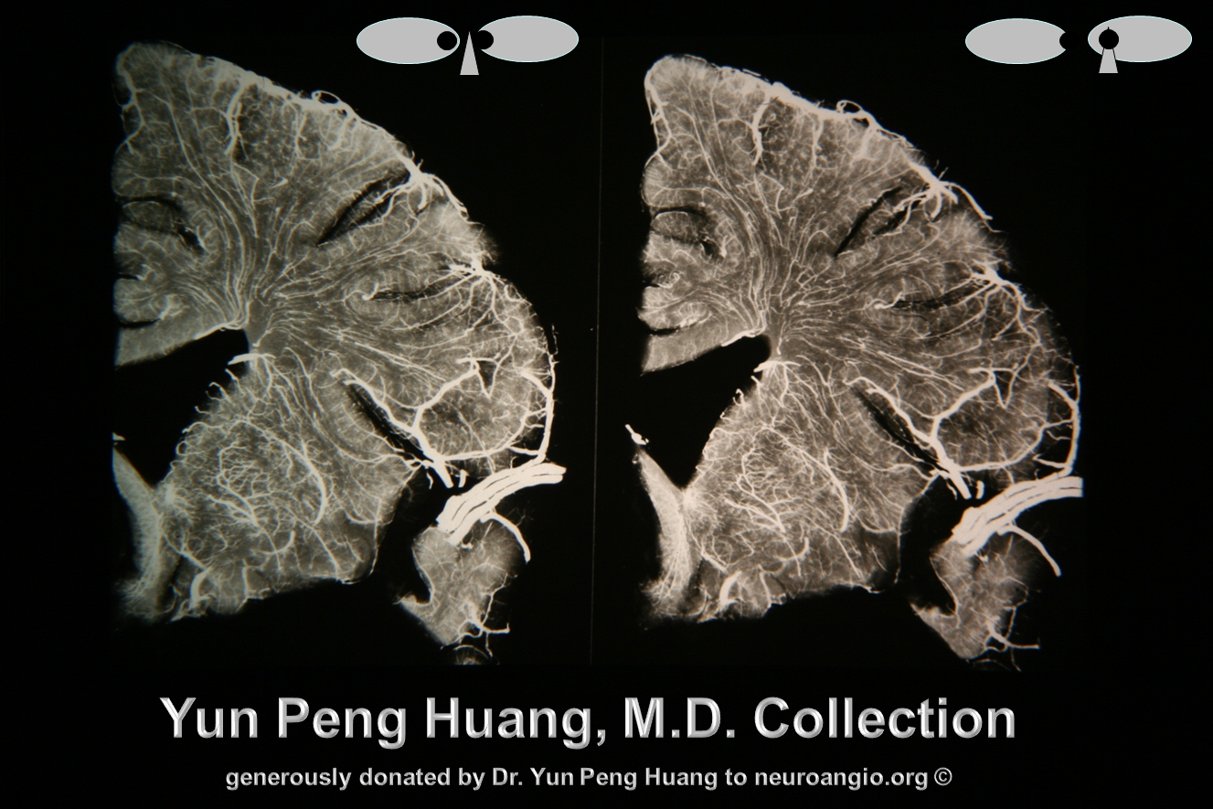 Yun Peng Huang MD transmedullary veins