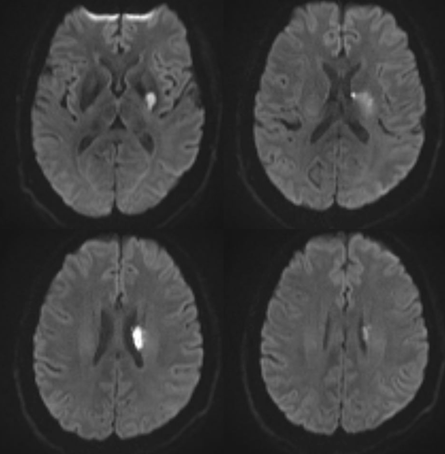 Spinal Vascular Anatomy Neuroangio Org